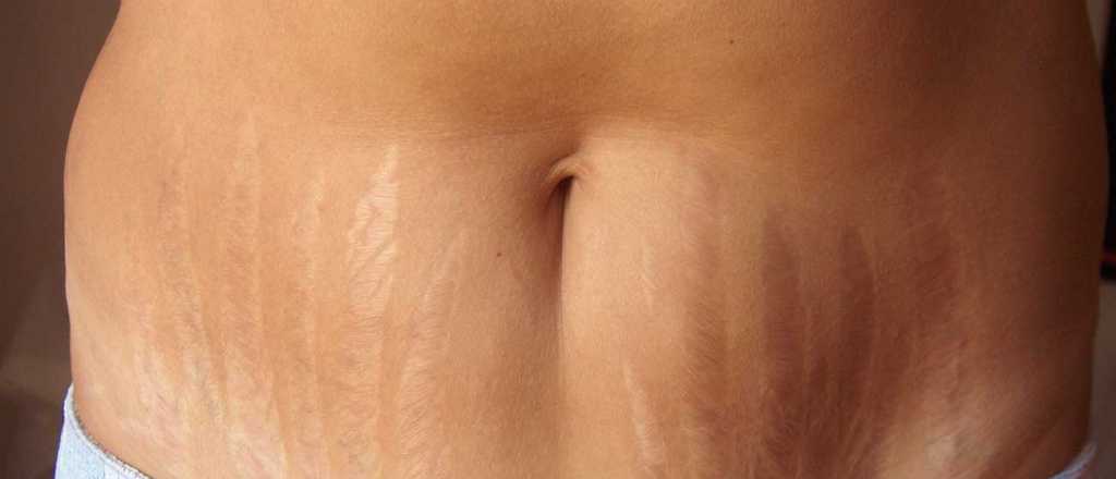 Cómo tratar en casa las estrías rojas antes de que se vuelvan blancas