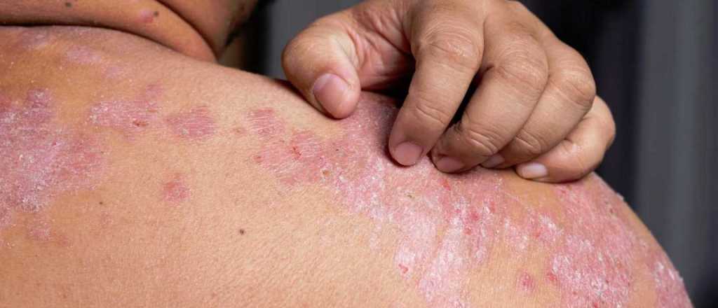 Ya está disponible un nuevo medicamento para la psoriasis en el país