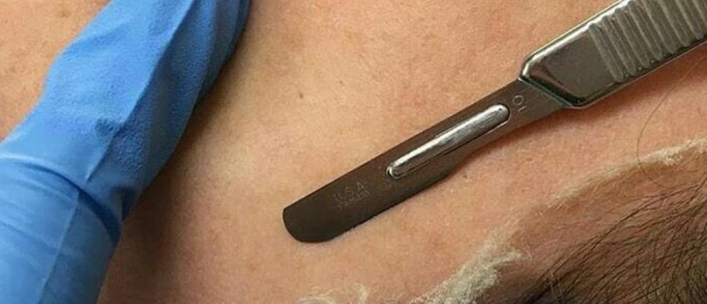 Dermaplaning: el tratamiento viral de Instagram ya está en Mendoza