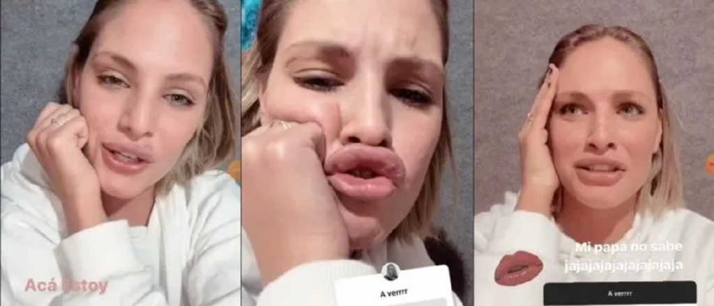 Una influencer sanjuanina se puso ácido hialurónico en los labios y así quedó