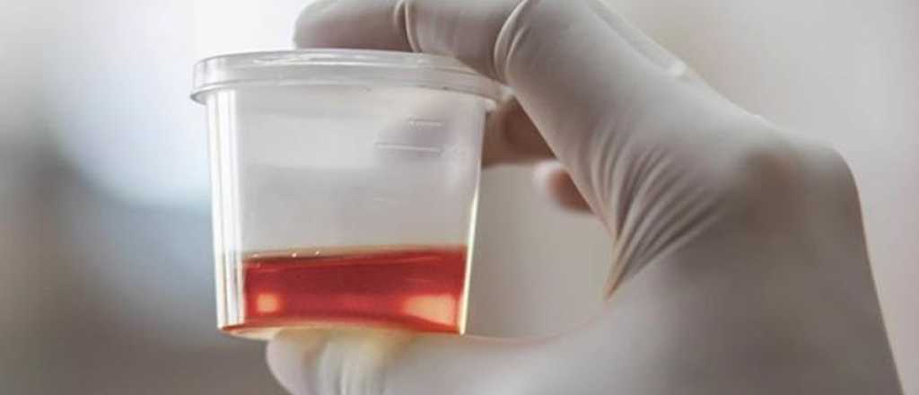 Hematuria, ¿Qué es? y sus causas