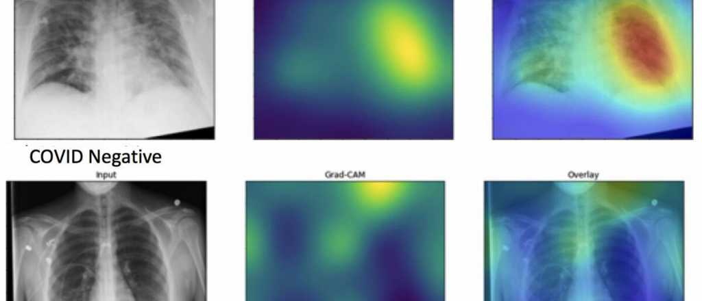 Los pulmones con Covid-19 se ven así con Inteligencia Artificial