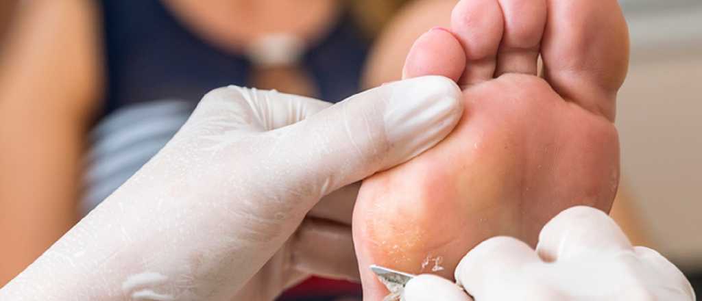 Con estos remedios caseros podrás eliminar los callos de los pies