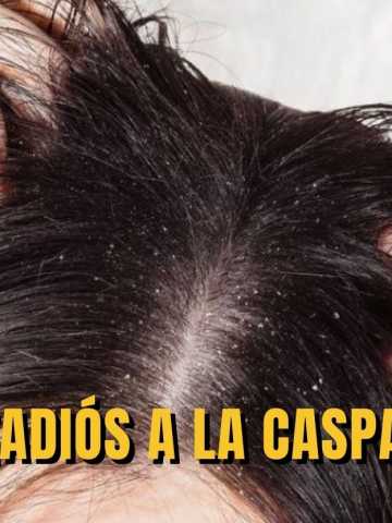 Todos los remedios naturales que eliminan la caspa para siempre - Mendoza  Post