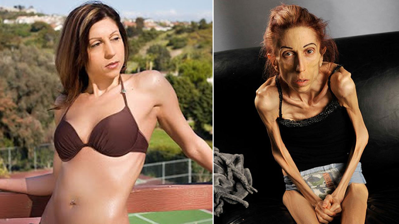 anorexia antes y despues