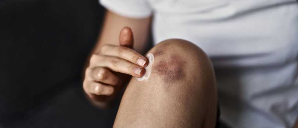 Moretones: ¿Cuándo es necesario consultar a un médico?