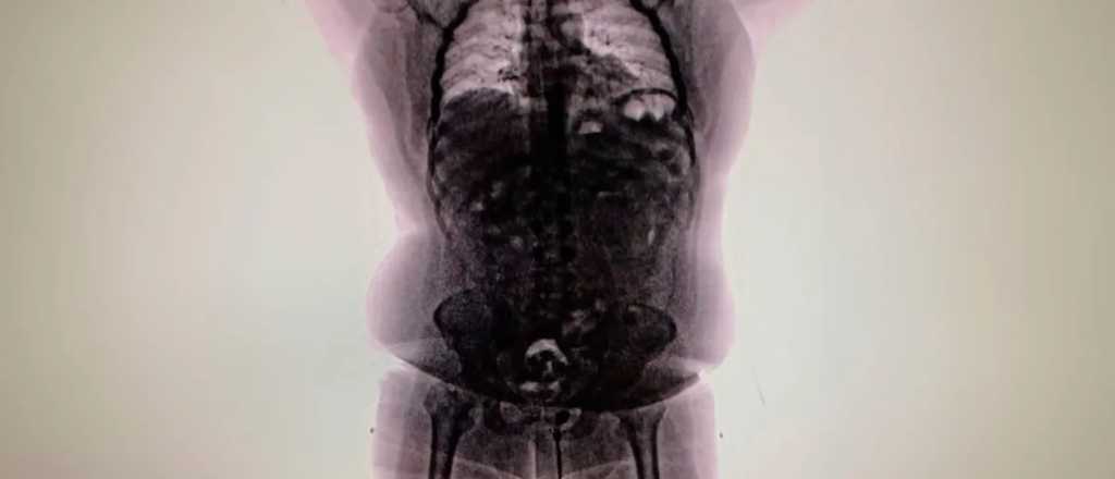 Aeropuerto de Ezeiza: cayó un peruano con cocaína en su aparato digestivo